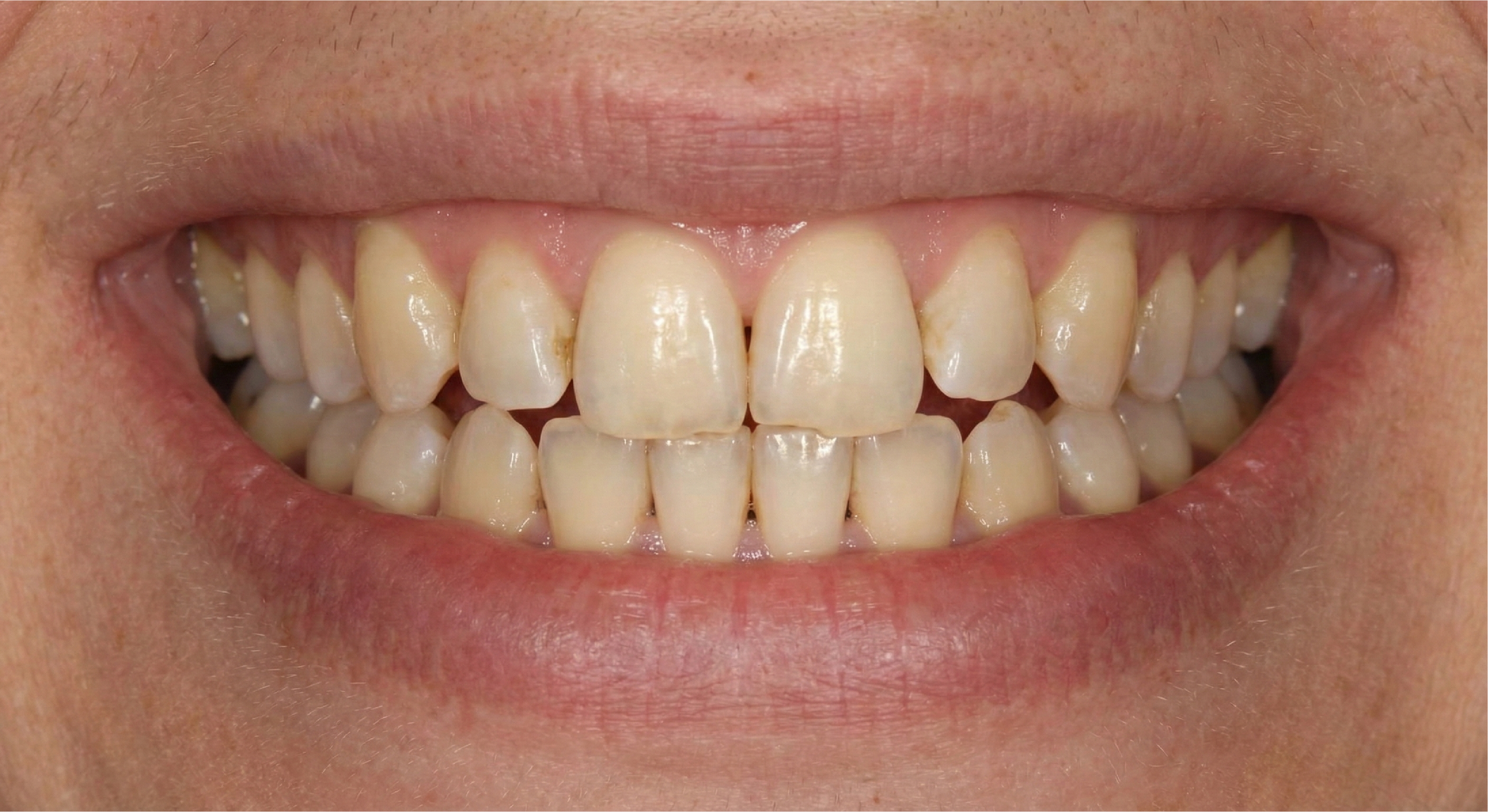 Before — Porcelain Veneers